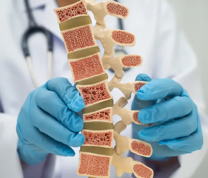 osteoporosi